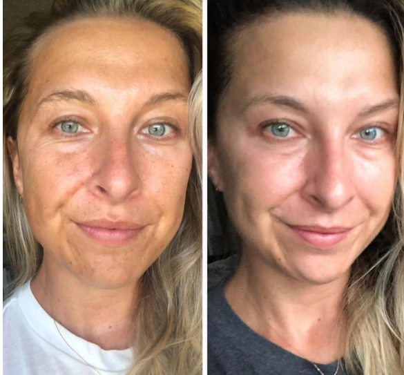 Derma Essential before and after real result